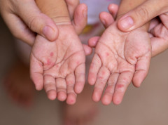 Od početka godine u Srbiji registrovano 197 slučajva malih boginja